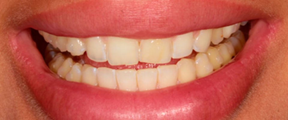 Antes del tratamiento: carillas sobre dientes apiñados y oscurecidos