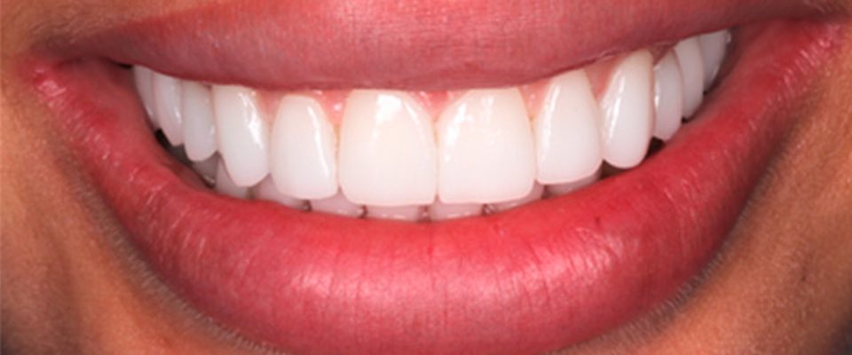 Después del tratamiento: carillas sobre dientes apiñados y oscurecidos