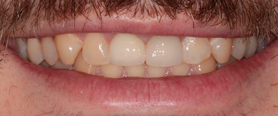 Antes del tratamiento: carillas sobre dientes desgastados