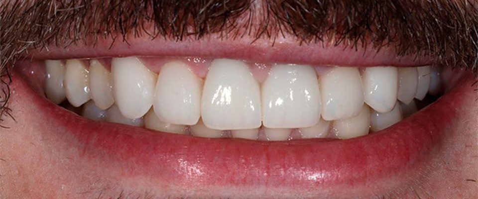Después del tratamiento: carillas sobre dientes desgastados