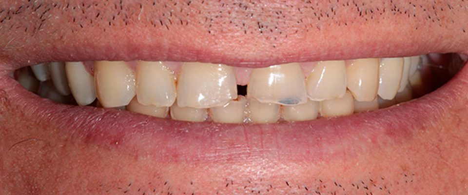 Antes del tratamiento: cierre de espacios entre dientes con carillas