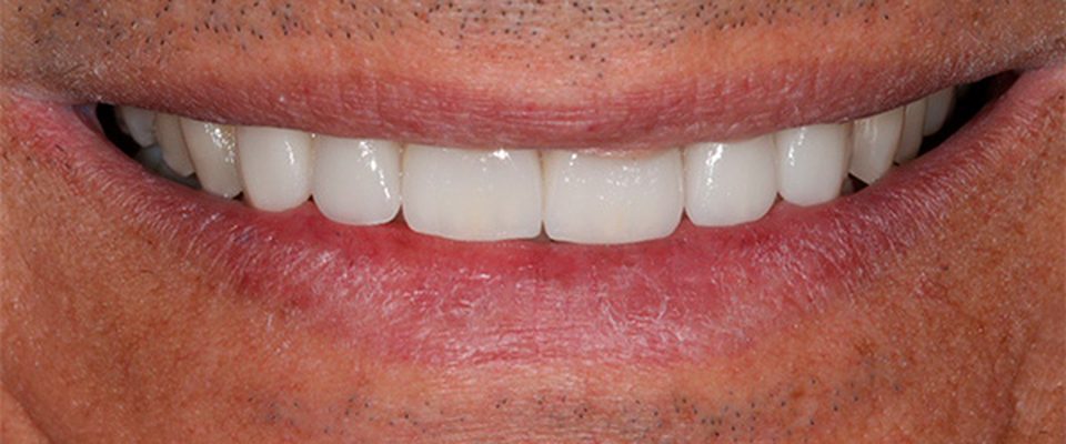 Después del tratamiento: cierre de espacios entre dientes con carillas