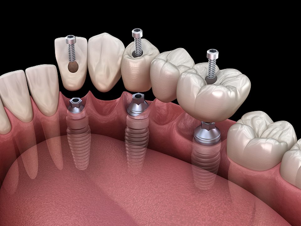 Digital planning of an implant position