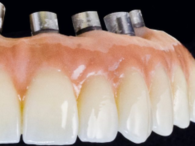 Implante de zirconio libre de metal