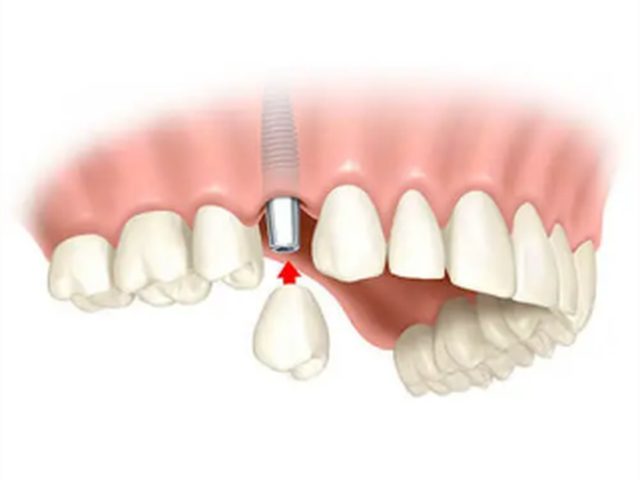 Single dental implant placed in the gap of a missing tooth