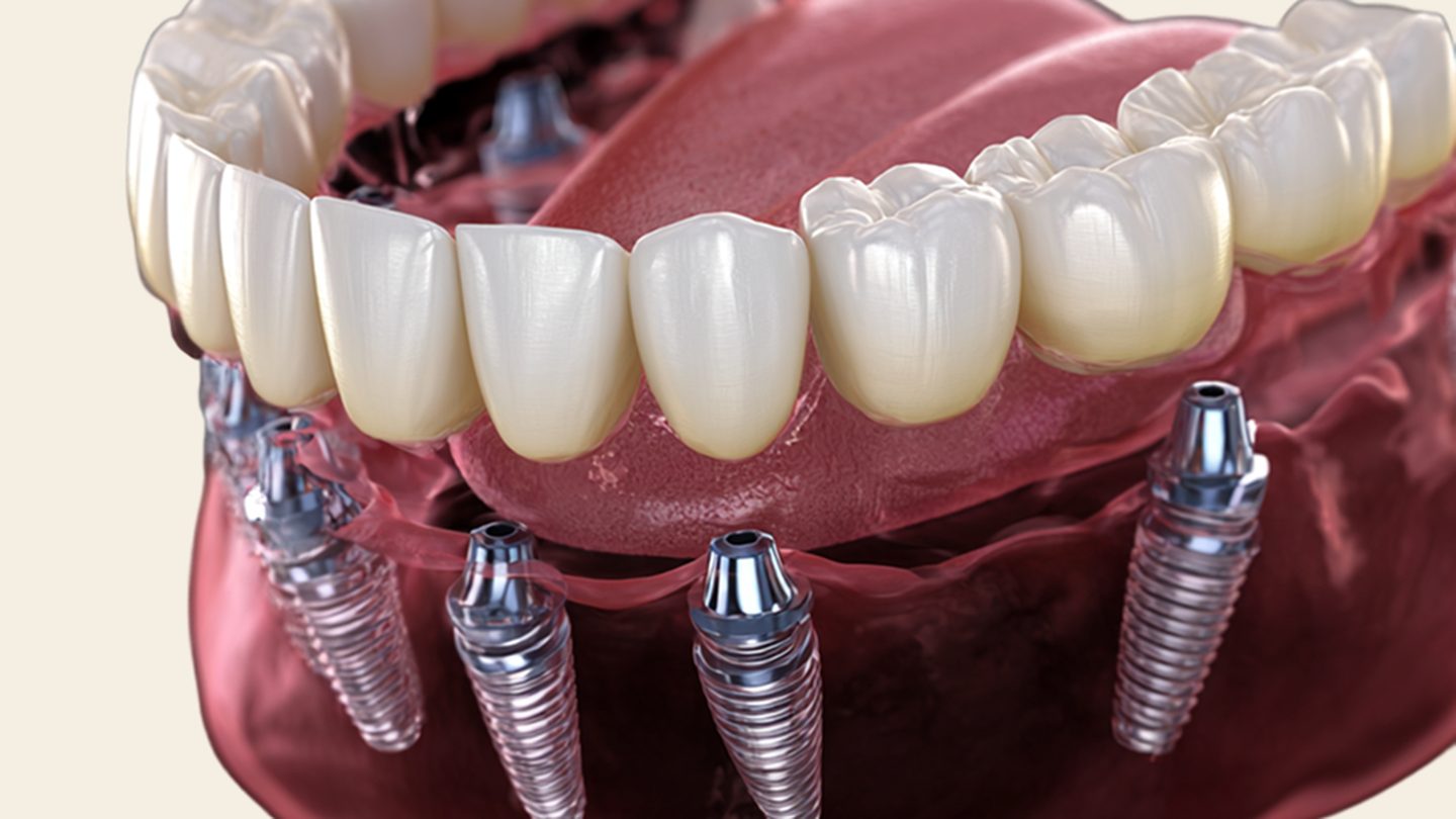 3D render of a full arch on implants