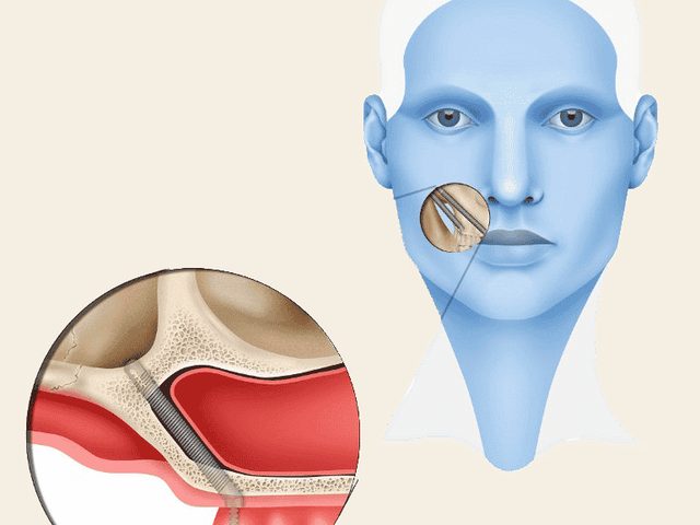 3D radiographic study for planning implants with bone loss