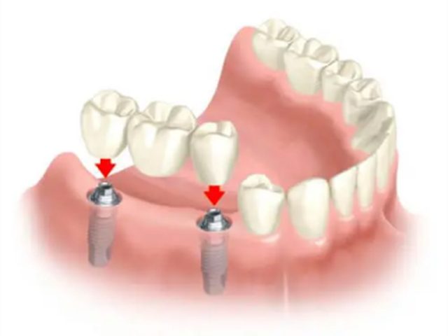 Dental bridge on implants replacing several teeth
